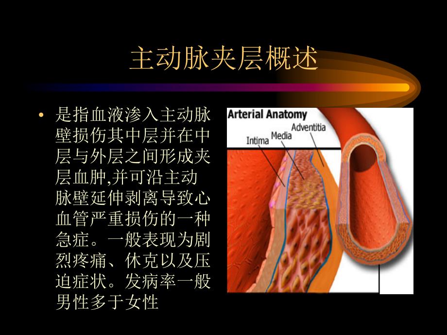 主动脉夹层讲课1幻灯片_第2页