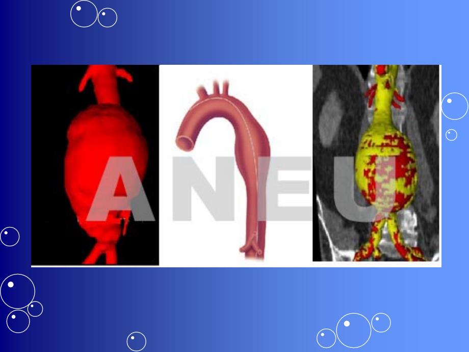 主动脉瘤及主动脉夹层的分型幻灯片_第3页