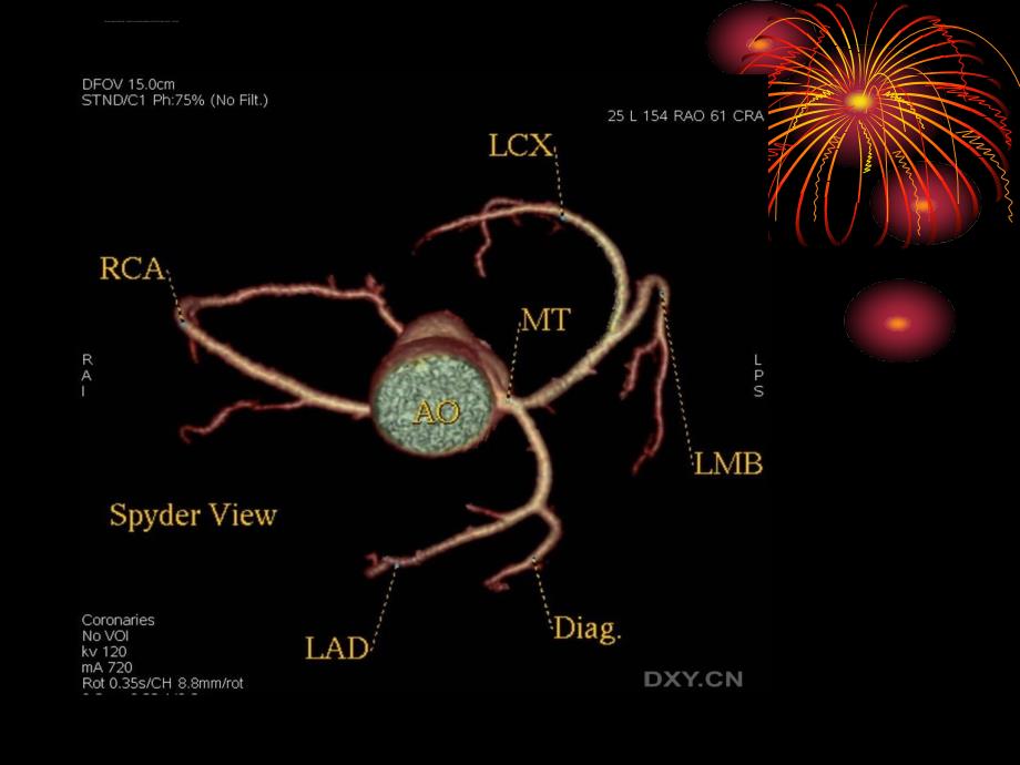 冠状动脉cta课件_第4页