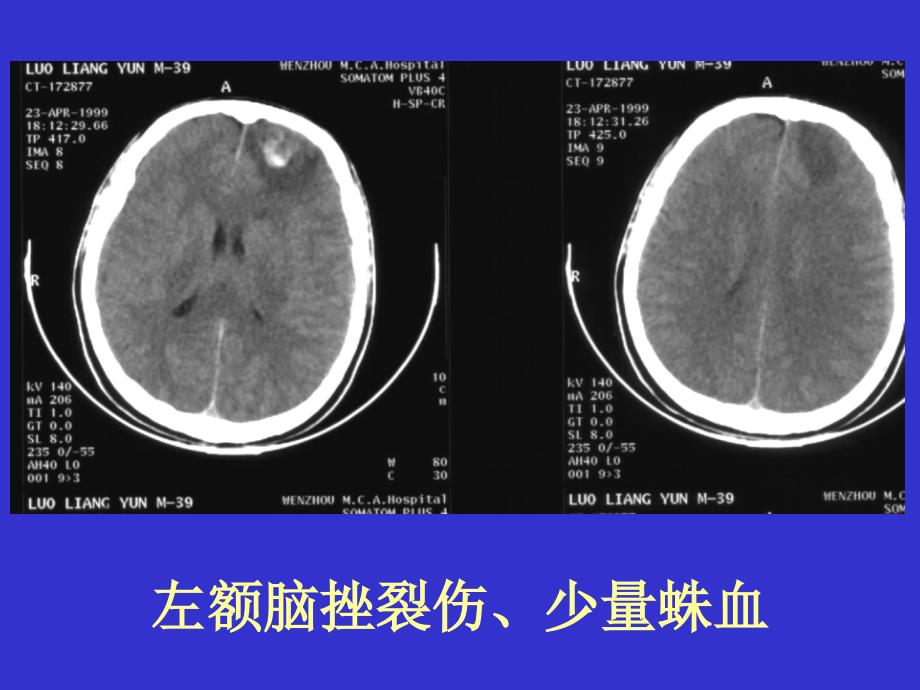 常见疾病的典型CT片_第4页