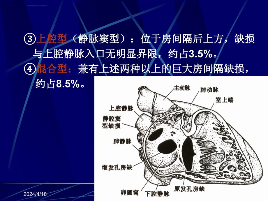 超声诊断学一先天性心脏病课件_第3页