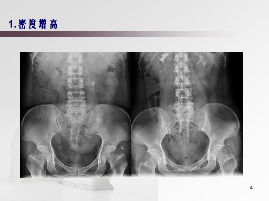 急腹症影像征象分析课件_第4页