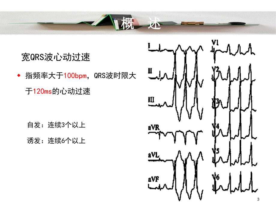 宽qrs波群心动过速鉴别诊断新思路_第3页