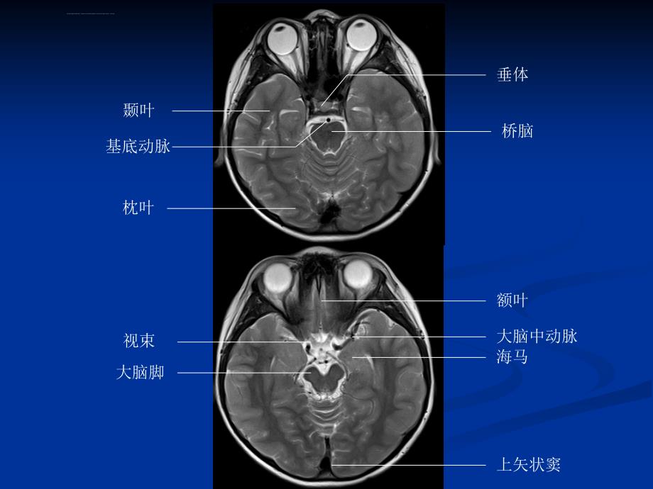 头颅ct与mri的正常图像课件_第4页