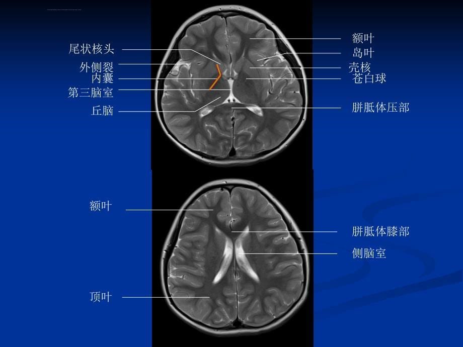 头颅ct与mri的正常图像课件_第5页