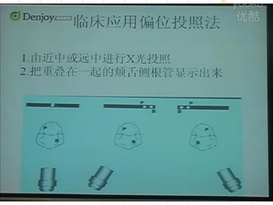 根管治疗的进步课件_第5页