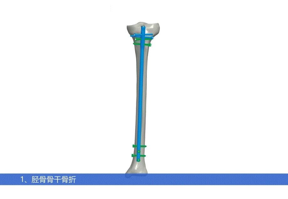 胫骨髓内钉操作指导课件_第5页