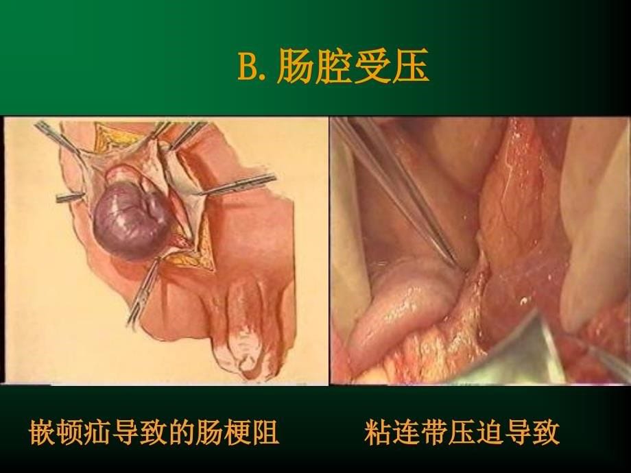 肠梗阻分析课件_第5页