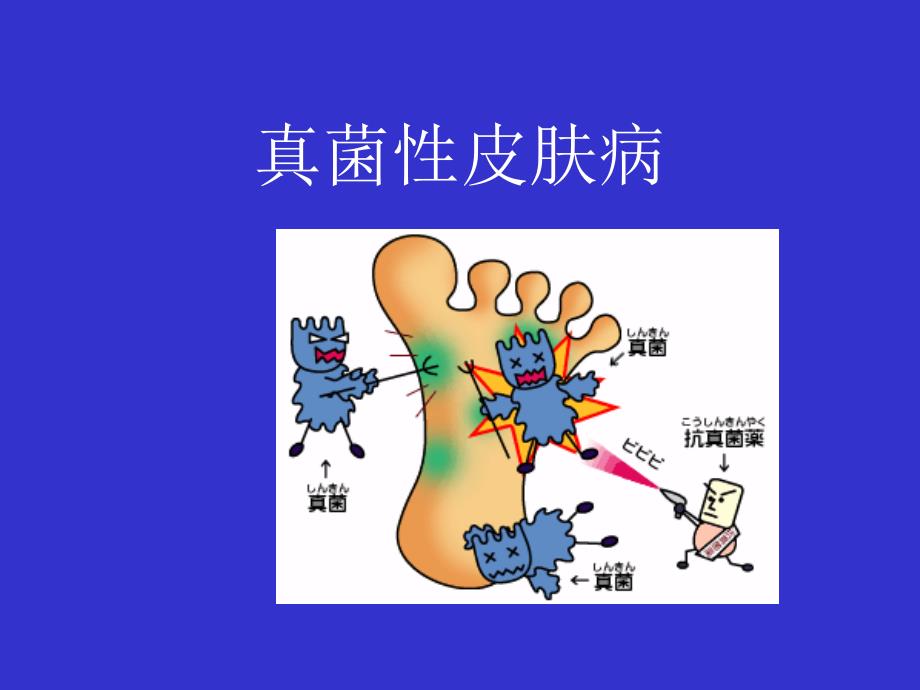 真菌性感染_第1页