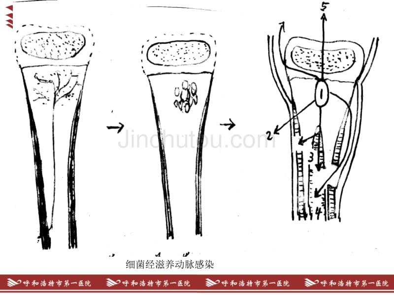 骨感染教学课件_第3页