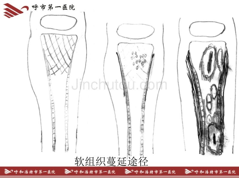 骨感染教学课件_第4页