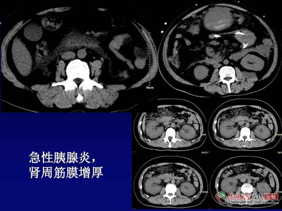 腹膜后间隙解剖及CT诊断PPT课件_第5页