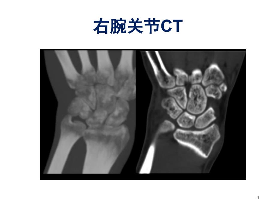 类风湿性关节炎影像与病理_第4页