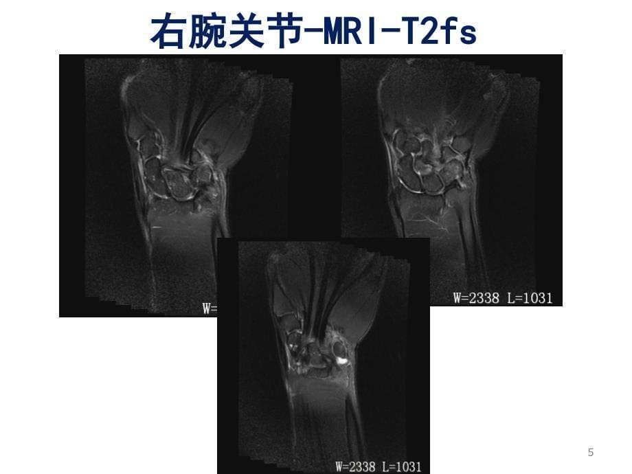 类风湿性关节炎影像与病理_第5页