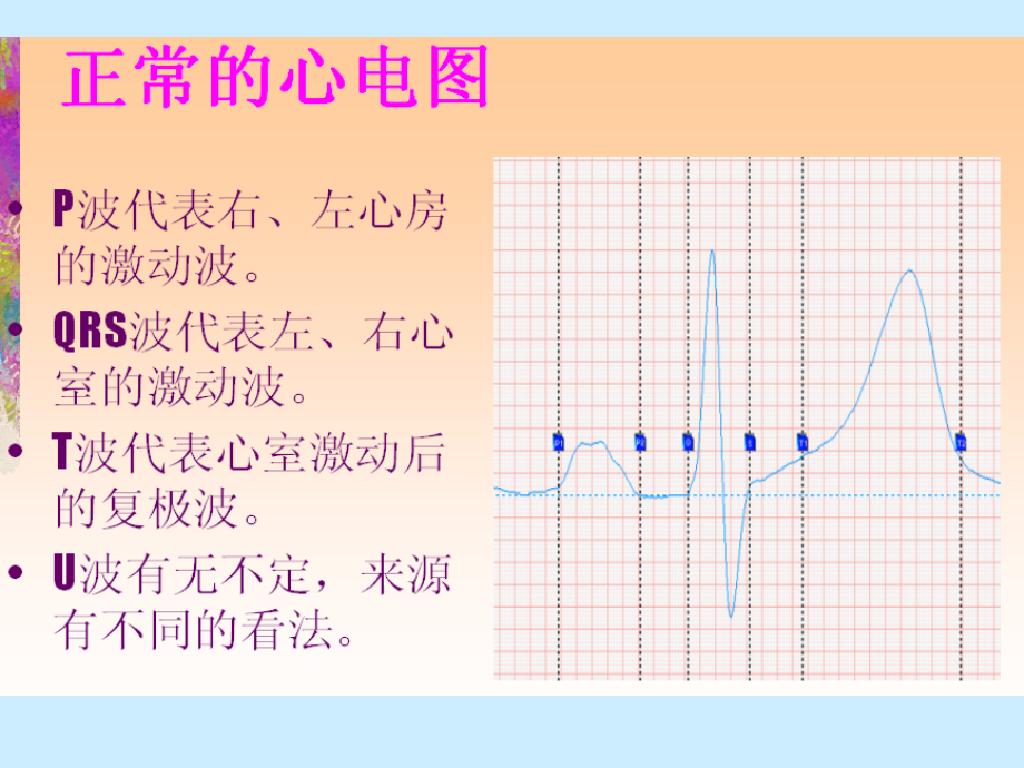 解读常见心电图_第2页