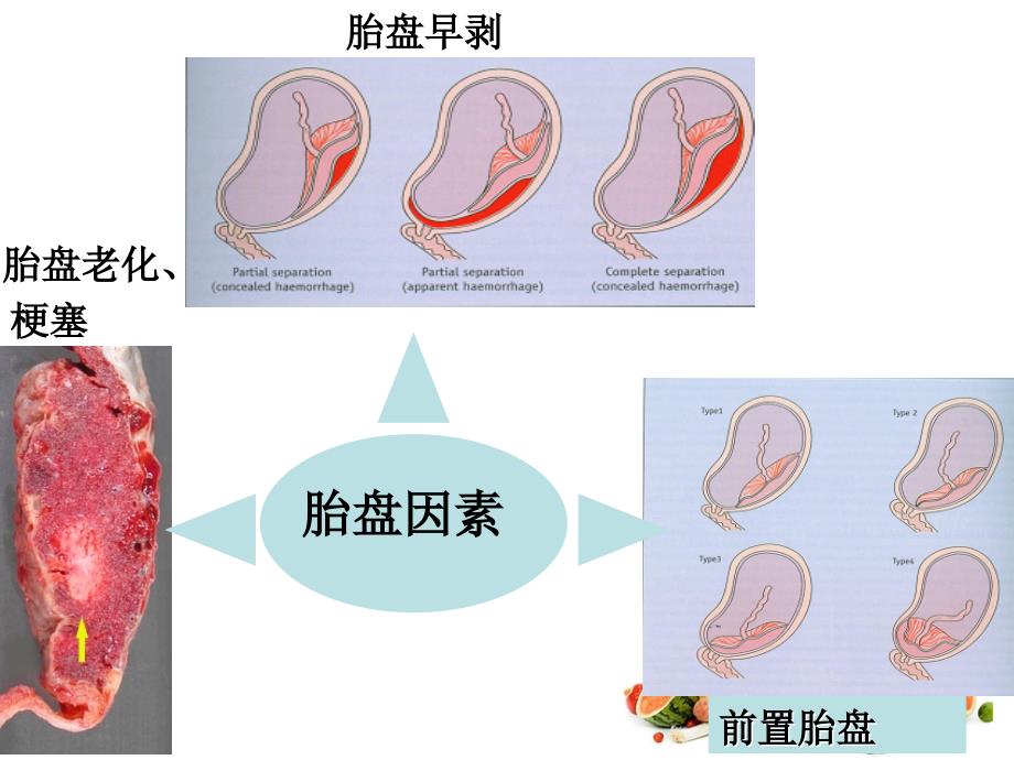 新生儿缺血缺氧性脑病护理_第4页