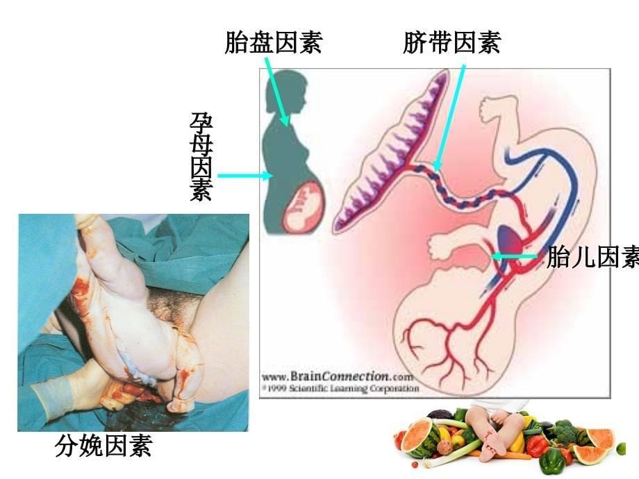 新生儿缺血缺氧性脑病护理_第5页