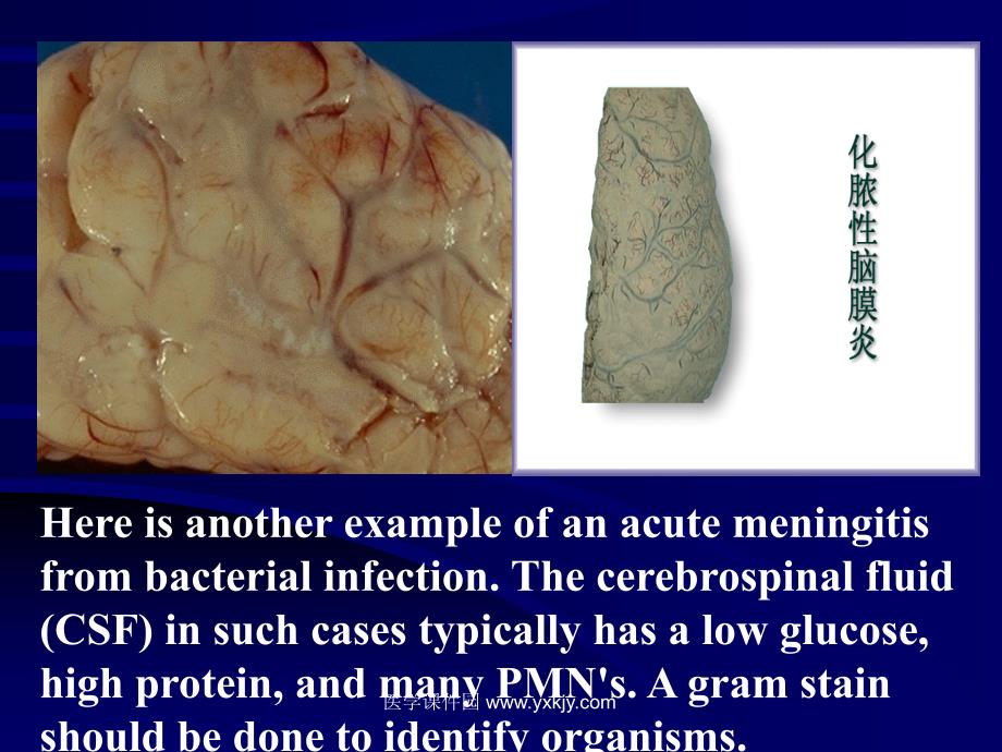 急性化脓性脑膜炎_第4页