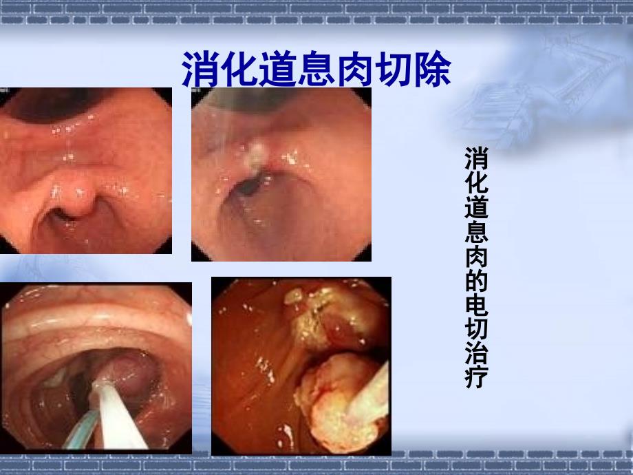 复件 内镜治疗2_第2页