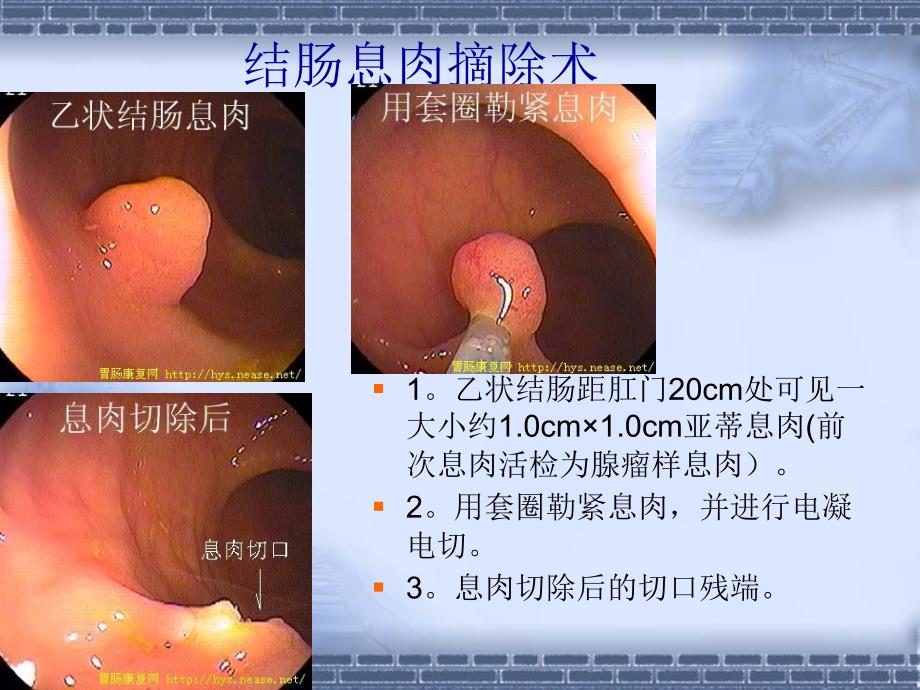 复件 内镜治疗2_第3页