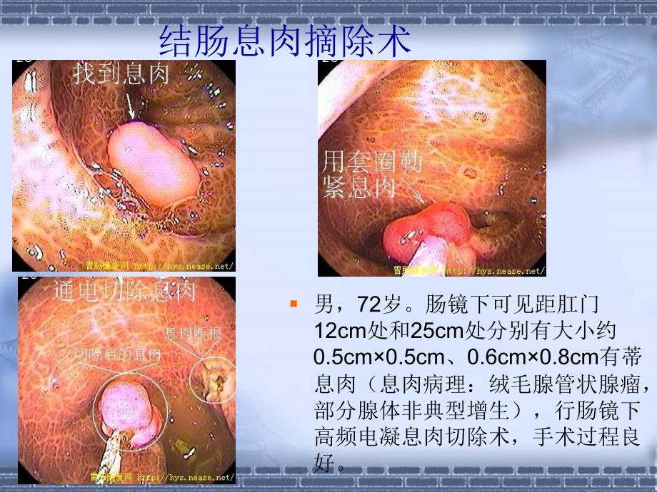 复件 内镜治疗2_第4页