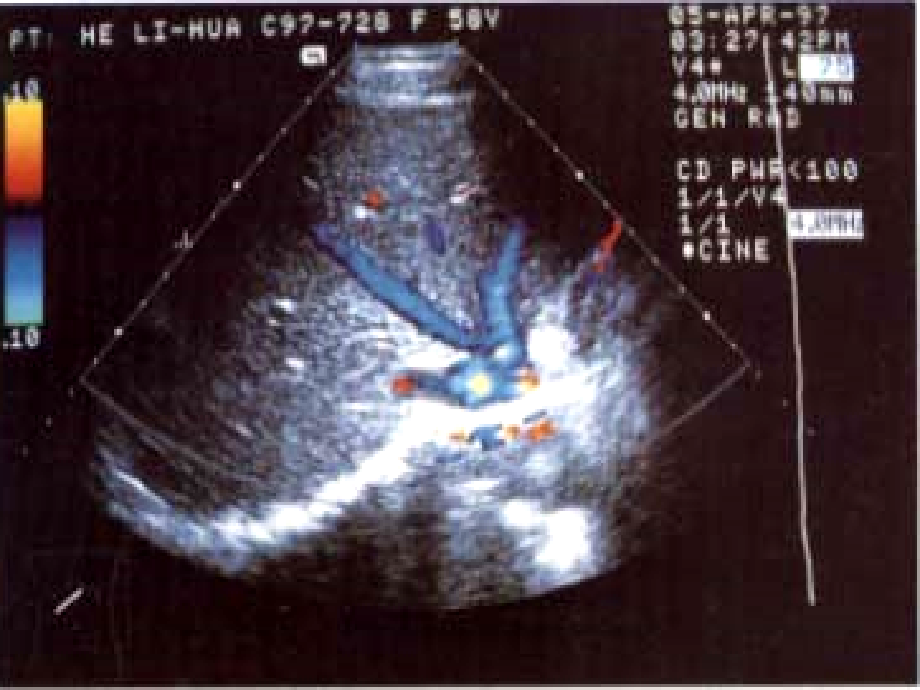超声诊断学-1肝脏 课件_第2页