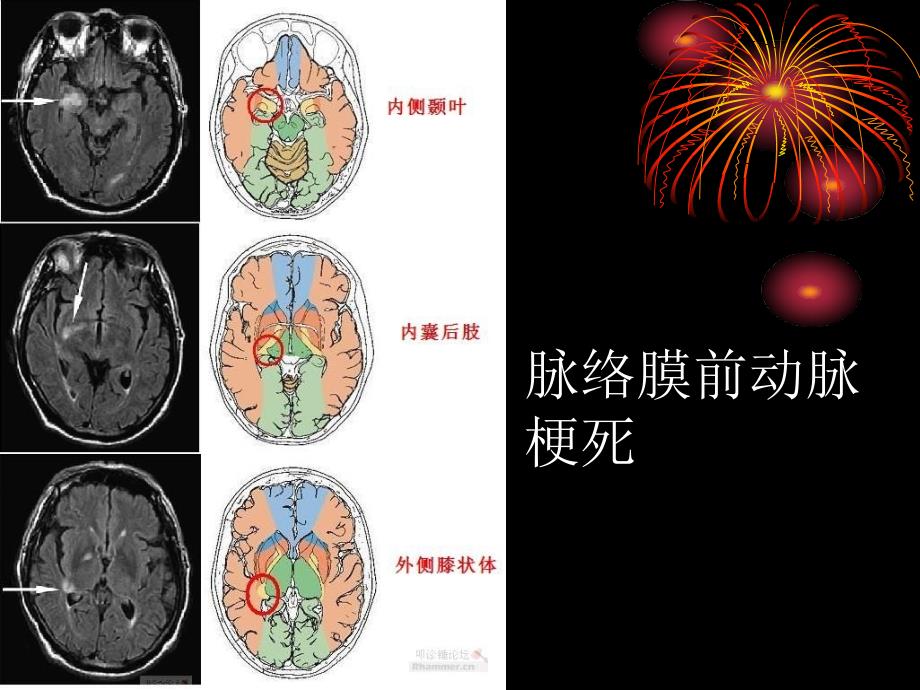 梗死部位和责任血管_第2页