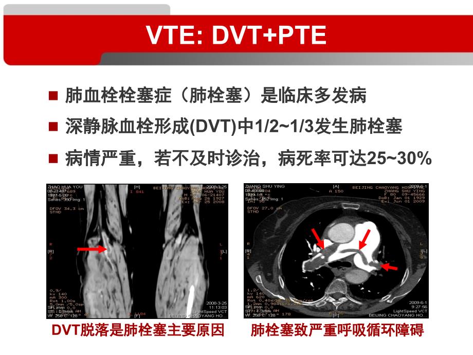 恶性肿瘤与静脉血栓栓塞症PPT_第2页