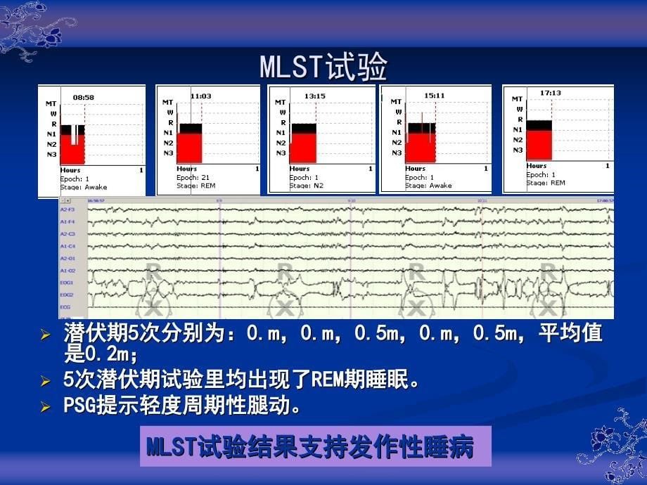 发作性睡病医学PPT_第5页