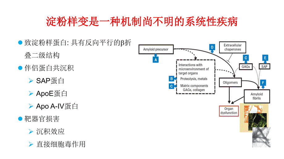 六。淀粉样变的诊断和分型进展李剑_第2页