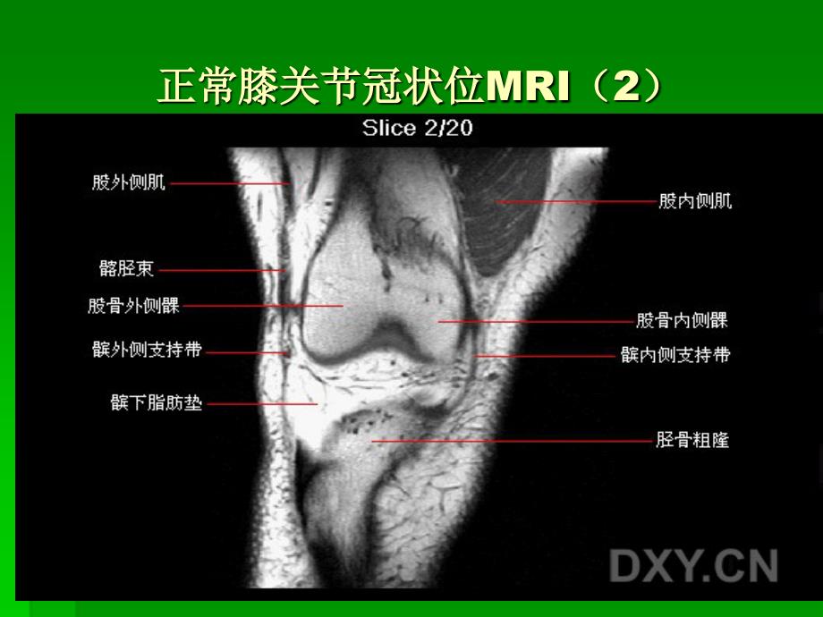 膝关节mri冠状位1_第2页