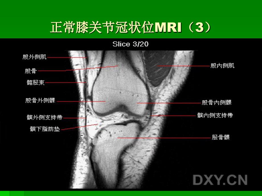 膝关节mri冠状位1_第3页