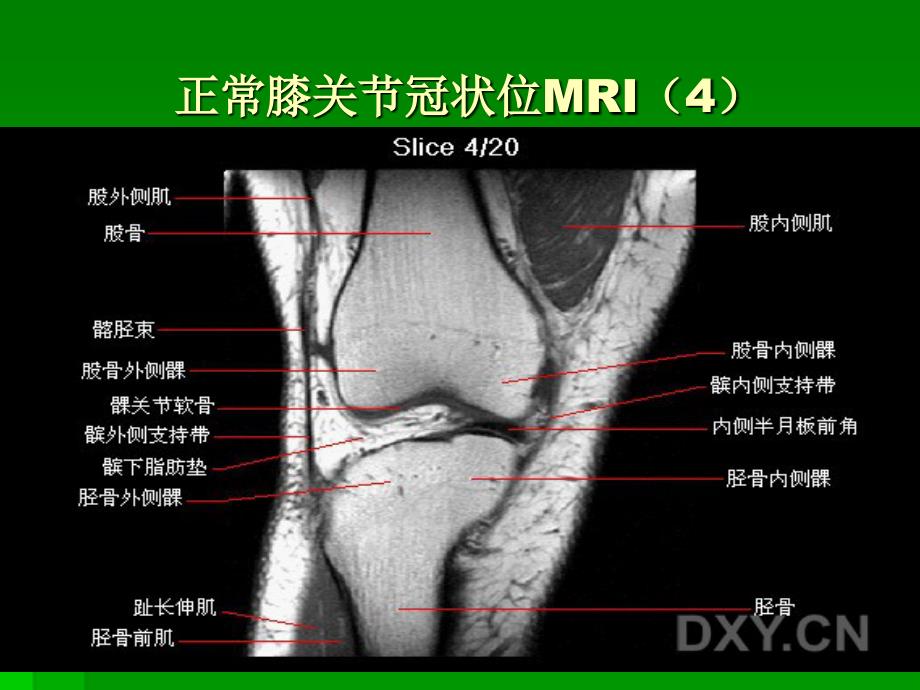 膝关节mri冠状位1_第4页