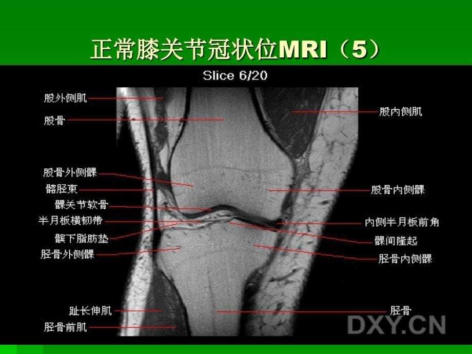 膝关节mri冠状位1_第5页