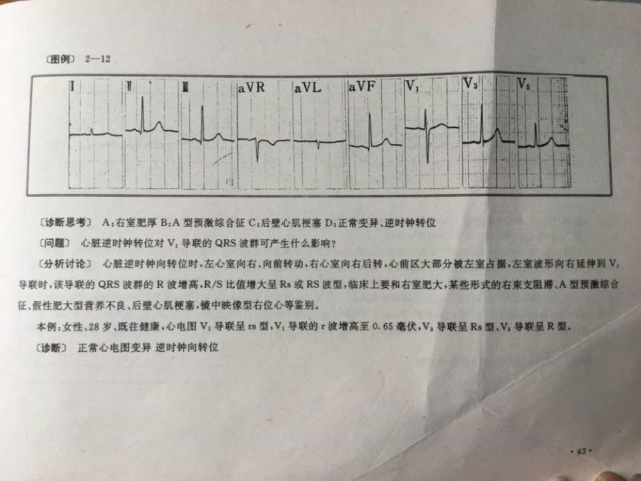 常见异常心电图诊断_第5页