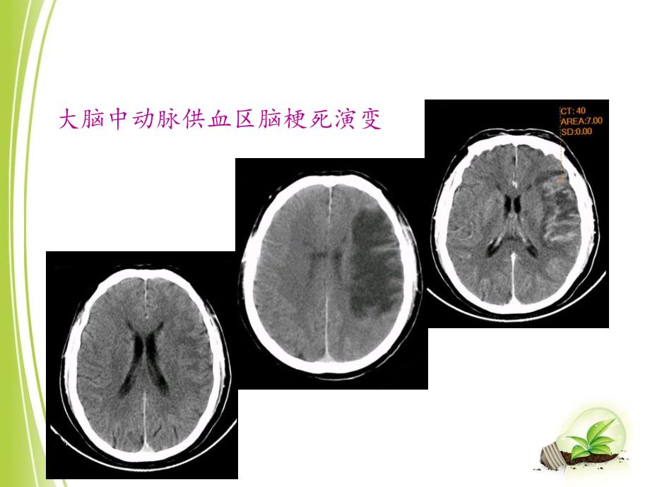 脑卒中的康复_第4页