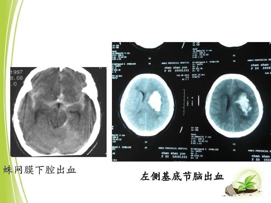 脑卒中的康复_第5页