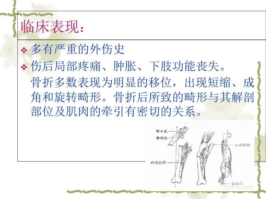 股骨干骨折的护理医学课件_第5页