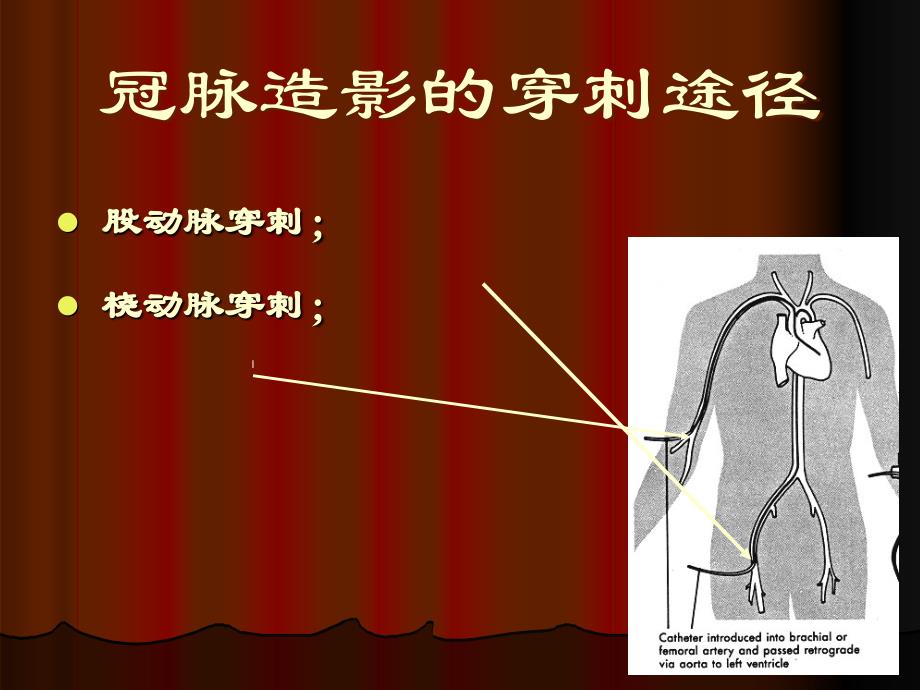 经股动脉冠脉造影术的术前术后护理 培训课件_第3页