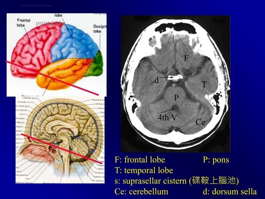 脑部的正常ct及mri解剖ppt培训课件_第5页