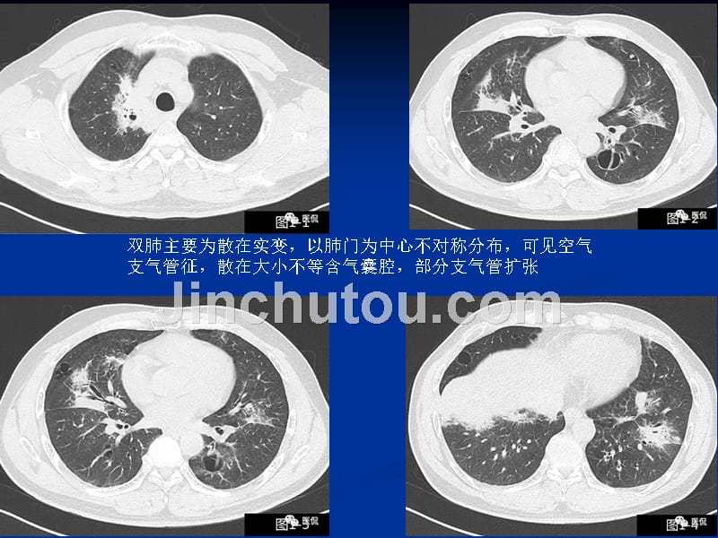 乳腺叶状肿瘤病例讨论_第4页