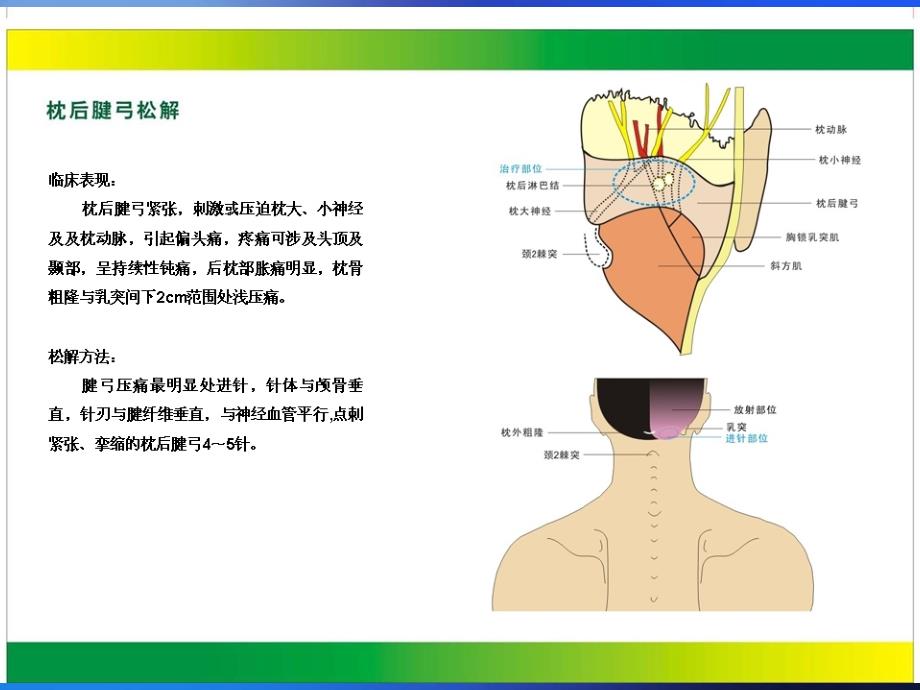 中华针刀治疗图解ppt培训课件_第3页