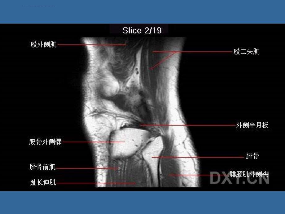 膝关节正常mri解剖ppt培训课件_第4页