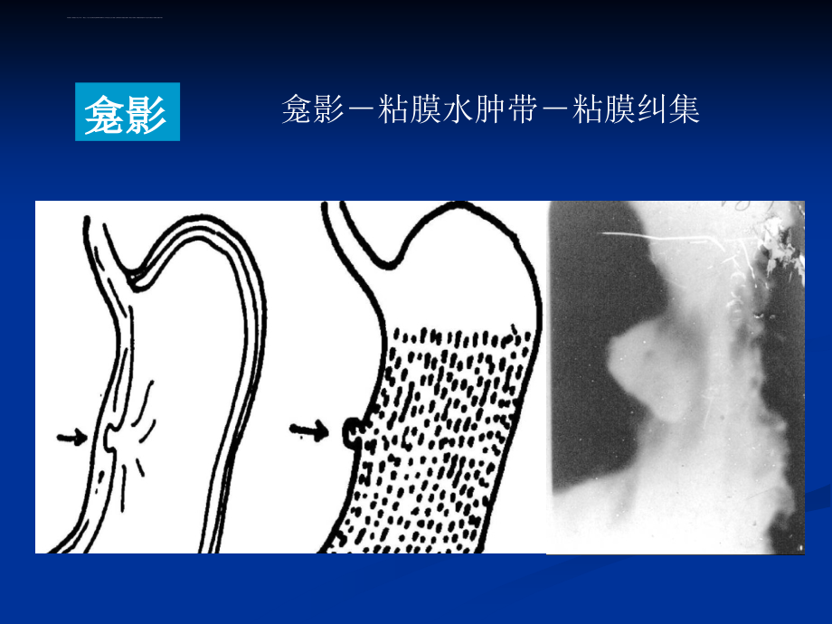 消化系统的影像学诊断2ppt培训课件_第4页