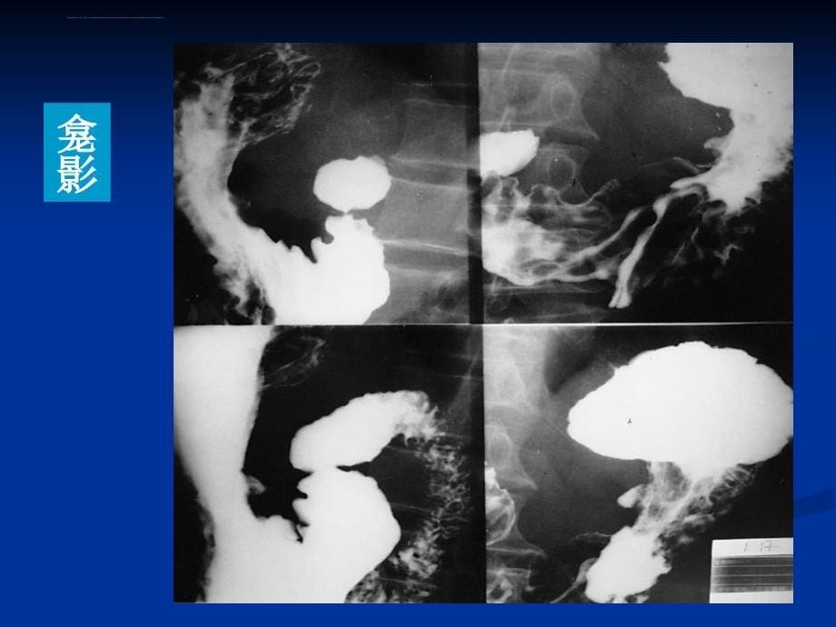 消化系统的影像学诊断2ppt培训课件_第5页