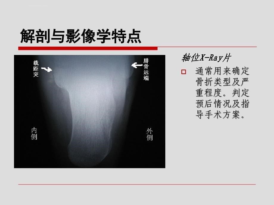 跟骨骨折的分型和治疗ppt培训课件_第5页