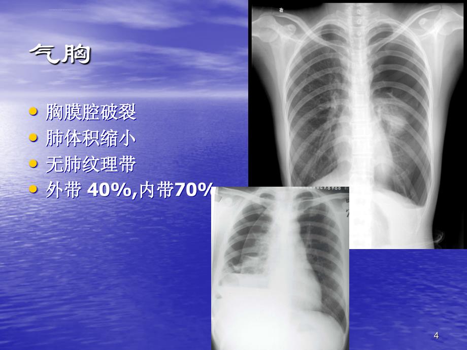 简化记忆x线ctb超（执业医师）多图技能考试ppt培训课件_第4页