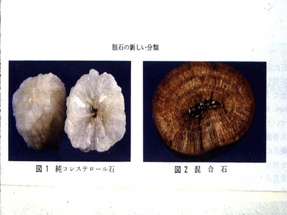 胆道结石课件_第4页