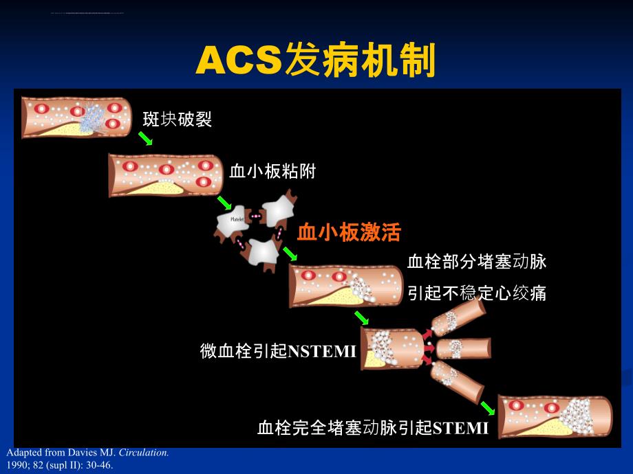 急性心肌梗死心内科ppt培训课件_第3页