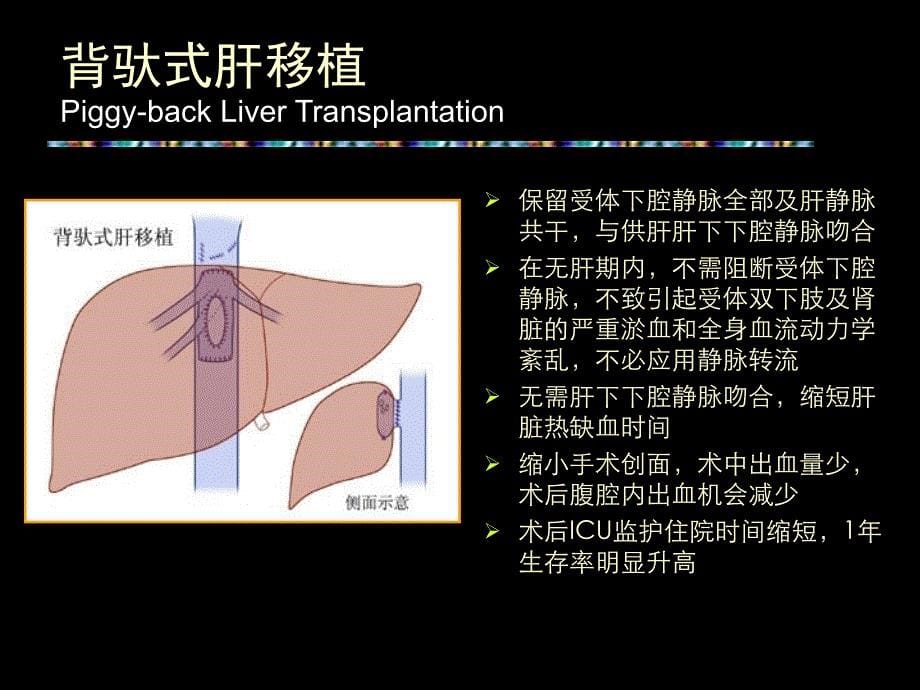 肝脏移植治疗终末期肝病课件_第5页